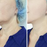 Kybella in Knoxville, Tennessee
