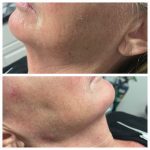 Jaw Line Filler in Knoxville, Tennessee