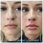 Lip Filler in Knoxville, Tennessee