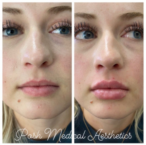 Lip Filler in Knoxville, Tennessee