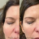 Cheek Filler in Knoxville, Tennessee