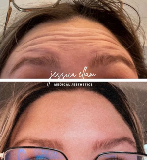 Forehead Filler in Knoxville, Tennessee