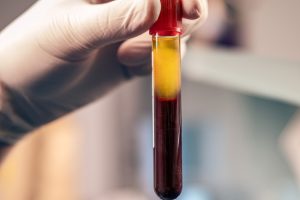 Uses and Benefits of Platelet Rich Plasma